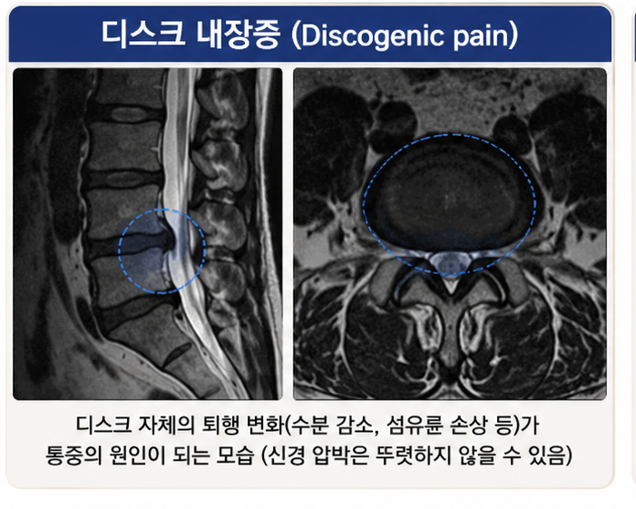 디스크 내장증의 디스크 퇴행과 내부 변화 개념을 설명하는 MRI 이미지