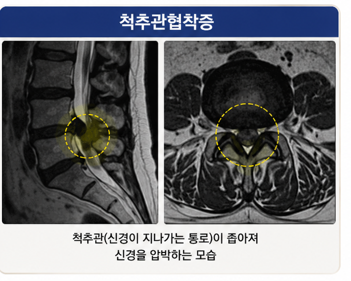 척추관협착증 MRI에서 신경 통로가 좁아진 모습을 설명하는 이미지